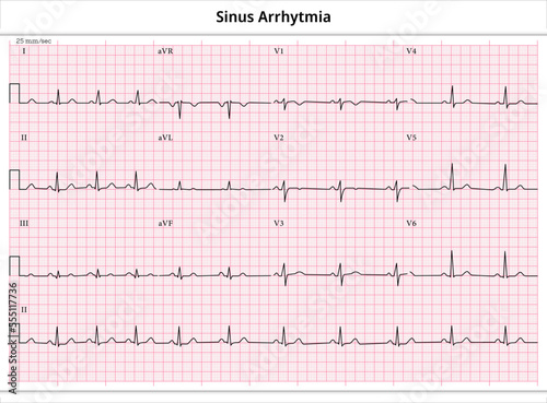 ECG Sinus Arrhytmia - 12 Leads ECG Paper