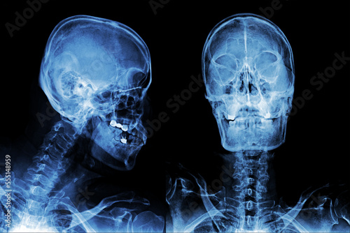 X-ray AP and lateral, X-ray image of skull frontal and side view
