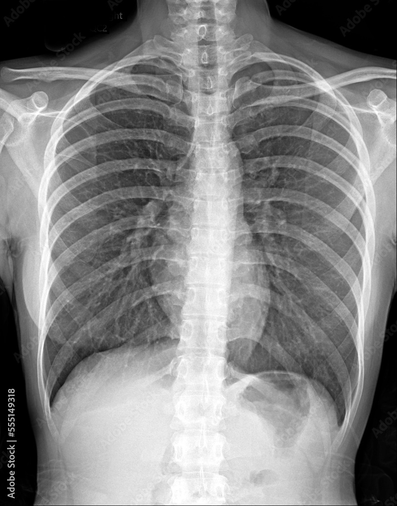 Foto de Pneumonia ( film chest xray show alveolar infiltrate at right