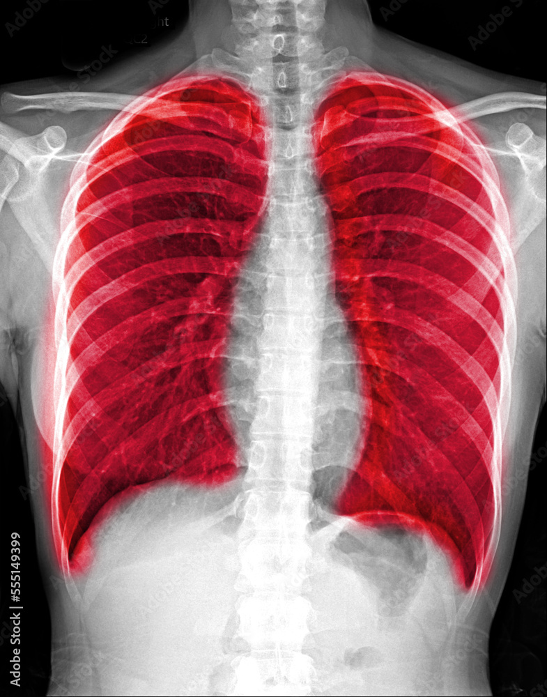 Pneumonia ( film chest xray show alveolar infiltrate at right middle