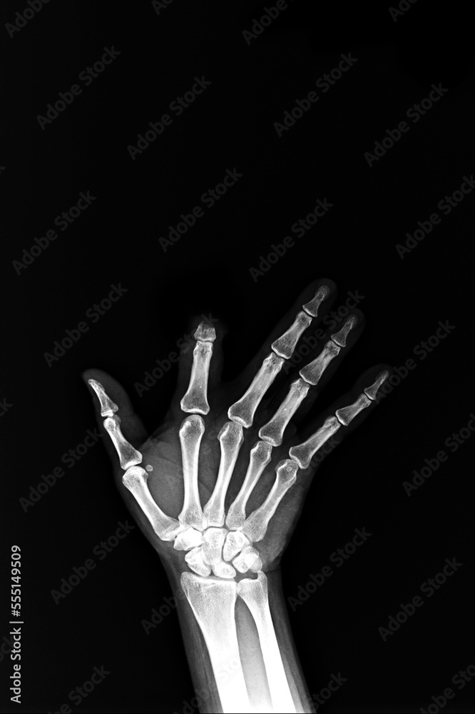 ( film x-ray index facture finger and hand ( facture is point a finger ) and inflame at finger ) ( film x-ray index facture finger and hand ( facture is point a finger ) and inflame at finger )