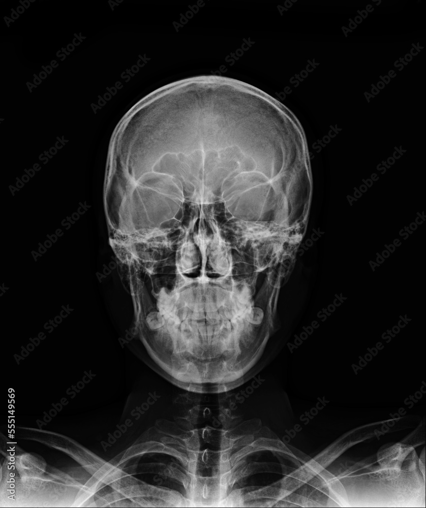 X-ray Lateral view skull and cervical spine . AP skull and cervical spine X-ray Lateral view skull and cervical spine . AP skull and cervical spine