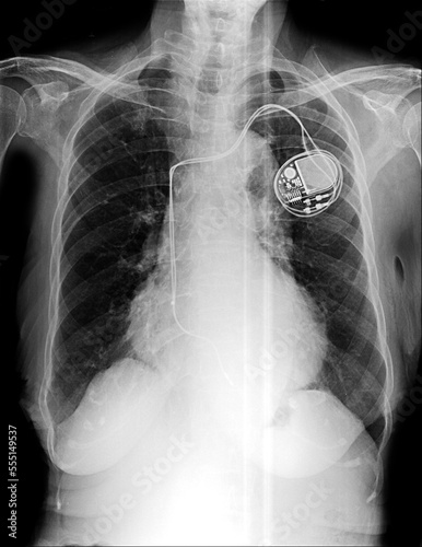 Film chest x-ray show pacemaker implantation in red area