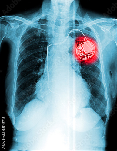 Film chest x-ray show pacemaker implantation in red area