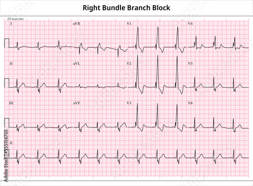 ECG RBBB (Right Bundle Branch Block) - 12 Leads ECG Paper