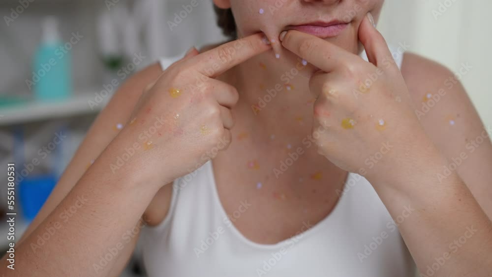 Ill unrecognizable woman scratching monkey pox rash on face front view ...