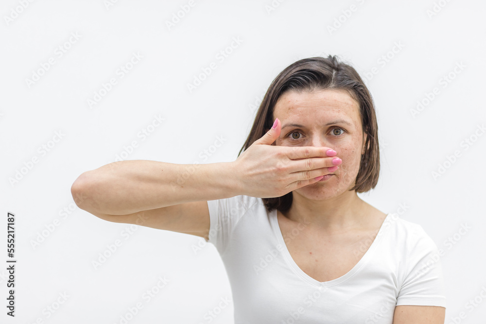 Photo of woman having skin problems and feeling bad because of it. Photo of woman having skin problems and feeling bad because of it.