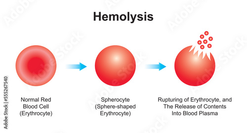 Scientific Designing of Hemolysis. The Destruction of Red Blood Cells. Colorful Symbols. Vector Illustration. photo