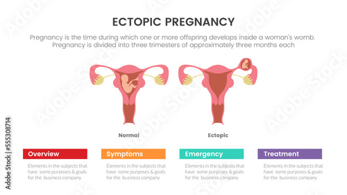 ectopic pregnant or pregnancy infographic concept for slide presentation with 3 point list photo
