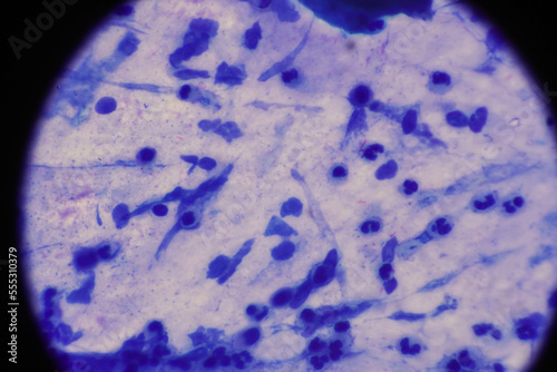 Mycobacterium tuberculosis appearance under the microscope is red with AFB staining