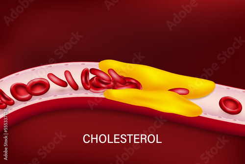 Cholesterol in blood vessels. Clogged arteries caused by cholesterol.