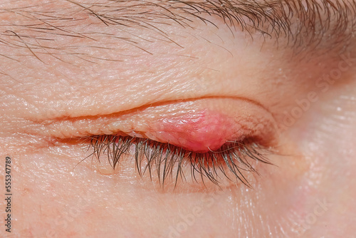 Chalazion on the eyelid of man macro. Demodicosis mite diseas, demodex. Eye of man with stye close-up. Man's eye with swollen, inflamed eyelid. Eyelid abscess. Eye infection, hordeolum.. photo