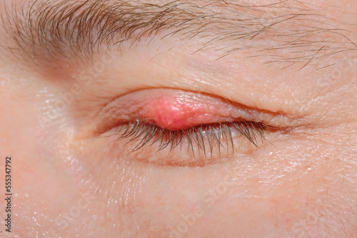 Eyelash demodicosis mite diseas, demodex. Chalazion on eyelid of man macro. Disease and treatment concept. Inflammation of the hair follicle of the eyelashes, human Demodex folliculitis. photo