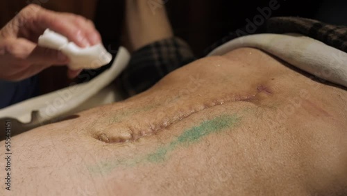 Patient care in outpatient treatment. Nurse holds cotton wool in her hand and processes postoperative suture on abdomen with antimicrobial antiseptic solution. Wound dressing procedure for hygiene