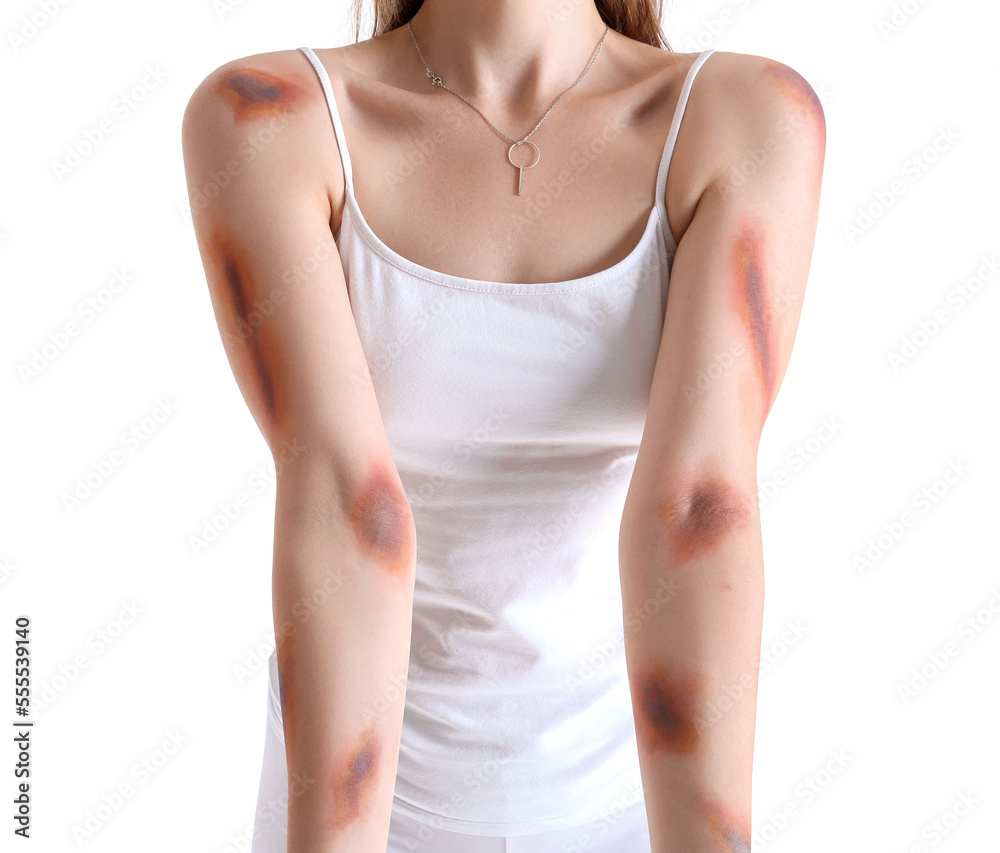 Young woman with bruised arms on white background