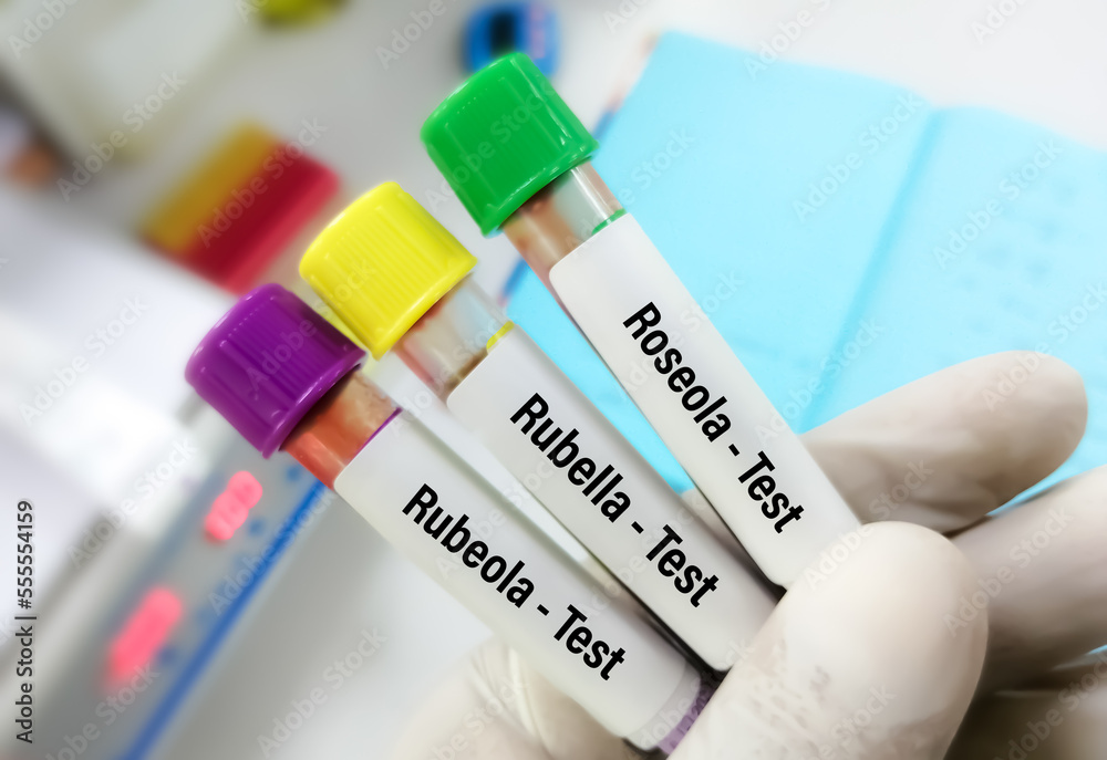 Scientist holding blood samples for Rubeola (measles), Rubella (German