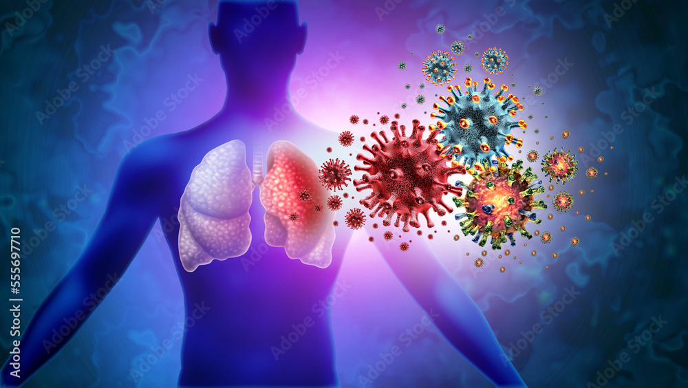 Triple Virus Lung Infection and Tripledemic Human lung infection and respiratory inflammation disease as influenza flu outbreak or pneumonia and pulmonary illness - obrazy, fototapety, plakaty 
