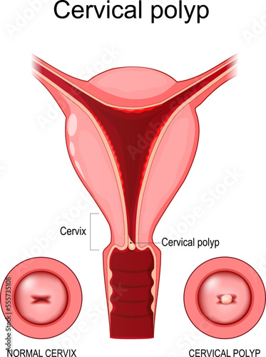 Cervical polyp. Normal cervix and benign tumor on the surface of the cervical canal.