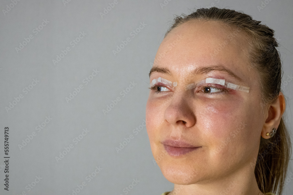 woman face after plastic surgery, blepharoplasty operation, swelling