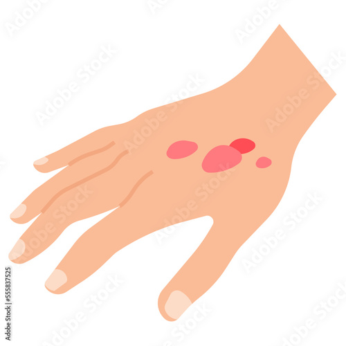 burns and scalds flat icon