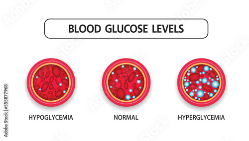 Hyperglycemia, High Blood Sugar and Diabetes ,obesity is a serious medical condition causes, vector design.