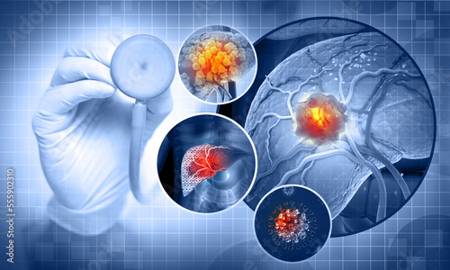 Liver cancer, Hepatocellular Carcinoma (HCC), conditions, causes and treatment. 3d illustration photo
