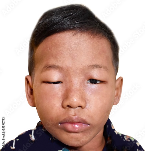 Angioedema at eyelids and lips of Southeast Asian child. Edematous child. Caused by drug, seafood or chemical allergy and insect bite.