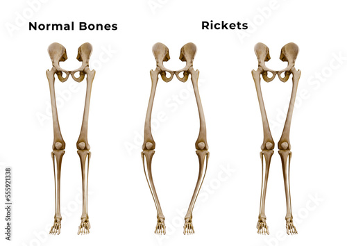 Rickets is a metabolic disease characterized by deformities of the bones. The most common symptoms are bowed legs photo