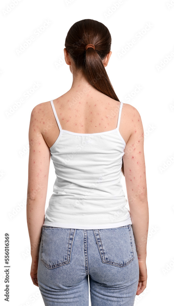 Woman with rash suffering from monkeypox virus on white background, back view Woman with rash suffering from monkeypox virus on white background, back view