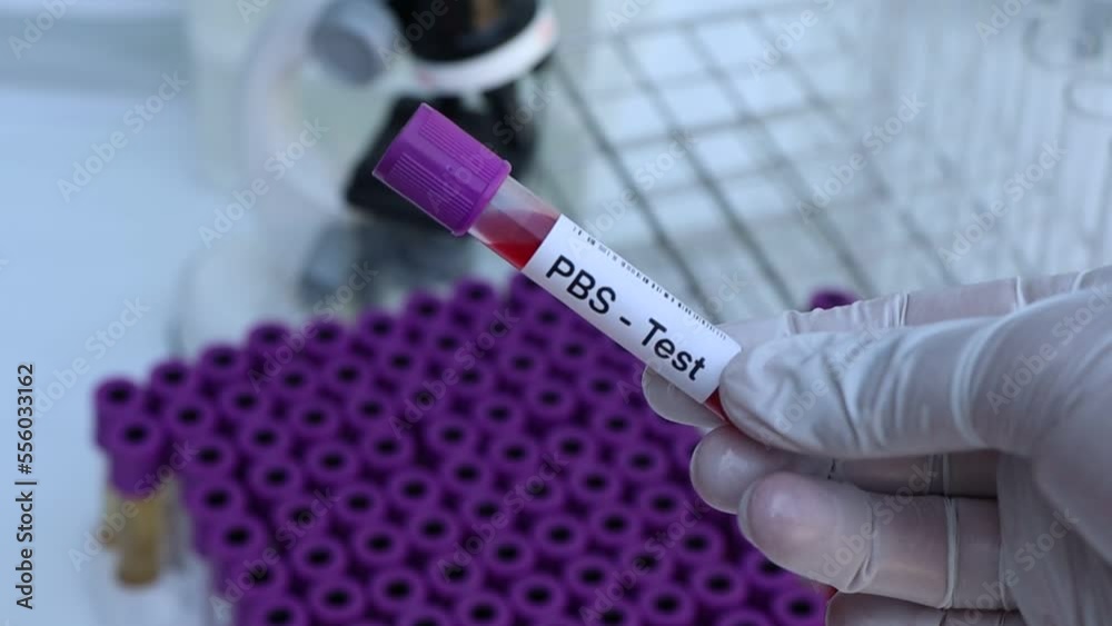 PBS test to look for abnormalities from blood, blood sample to analyze in the laboratory, blood in test tube PBS test to look for abnormalities from blood, blood sample to analyze in the laboratory, blood in test tube