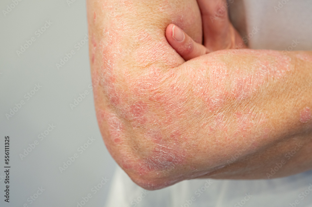 Fototapeta premium Skin disease psoriasis on arm and hand