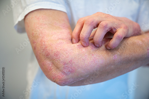 Itchy psoriasis on arm and hand photo
