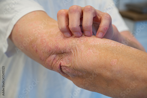 Itchy psoriasis on arm and hand photo