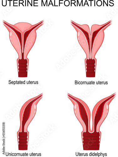 uterine malformations