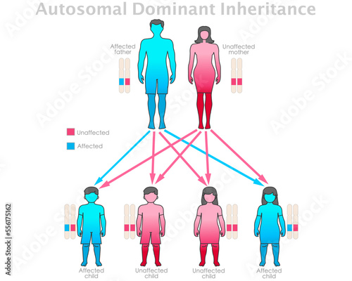 Autosomal dominant inheritance. Affected father, unaffected mother child, son, doughter. Red, blue dominance allele pattern recessive traits. Male, female human gene graph chart. Illustration vector