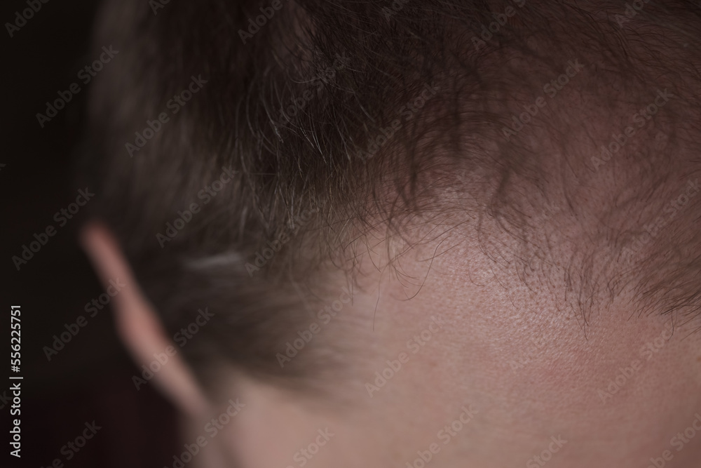 Men hair loss problem alopecia Men hair loss problem alopecia