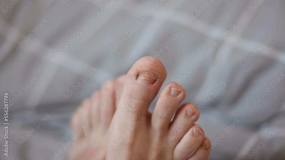 Video Stock Male big toe nail has been removed. Damaged big toe from