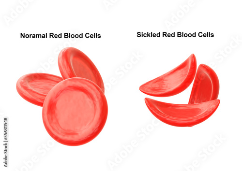 Sickle cell anemia is a hereditary disease characterized by the alteration of red blood cells, making them look like a sickle photo