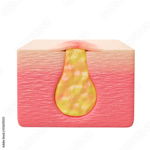 acne is the inflammatory process of the sebaceous glands and pilosebaceous follicles. Internal view of the pustule photo