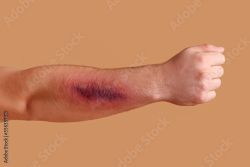Male arm with bruise on beige background