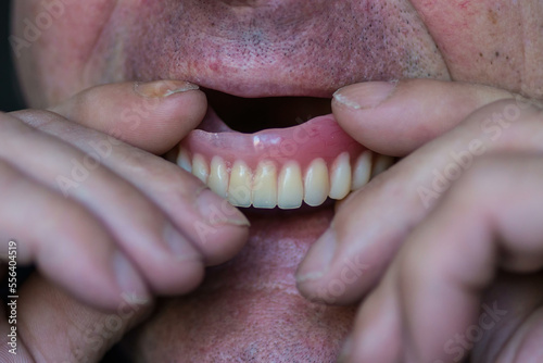 close-up pensioner puts on false teeth, an elderly man inserts removable dentures into his mouth. loss of teeth, dental prosthetics, dental services concept