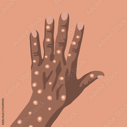 Vector isolated illustration of a hand of a black man with monkey pox. photo