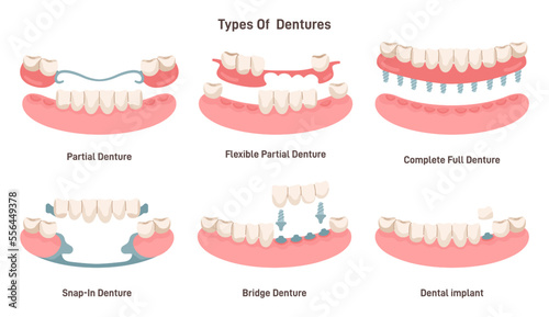 Dental prosthesis types set. Dental implant, partial, snap-in, bridge
