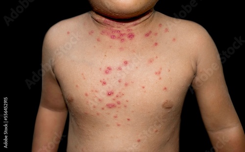 Molluscum contagiosum skin lesions also called water warts of Asian child. photo