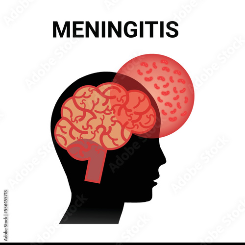 Meningitis inflammation of the brain, vector simple
