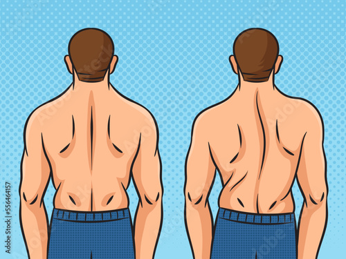 Man back with scoliosis pinup pop art retro vector illustration. Comic book style imitation.