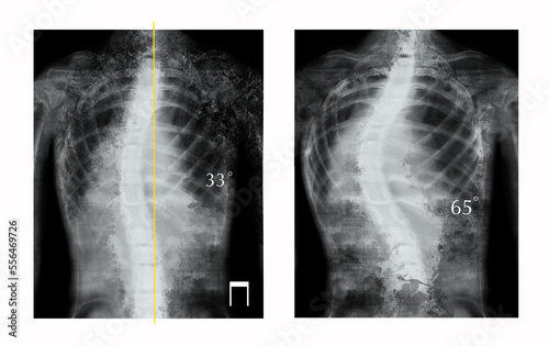 X-rays of human spine showing curvature. Patients suffering from scoliosis