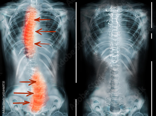 X-rays of human normal and curved spines. Patient suffering from scoliosis photo
