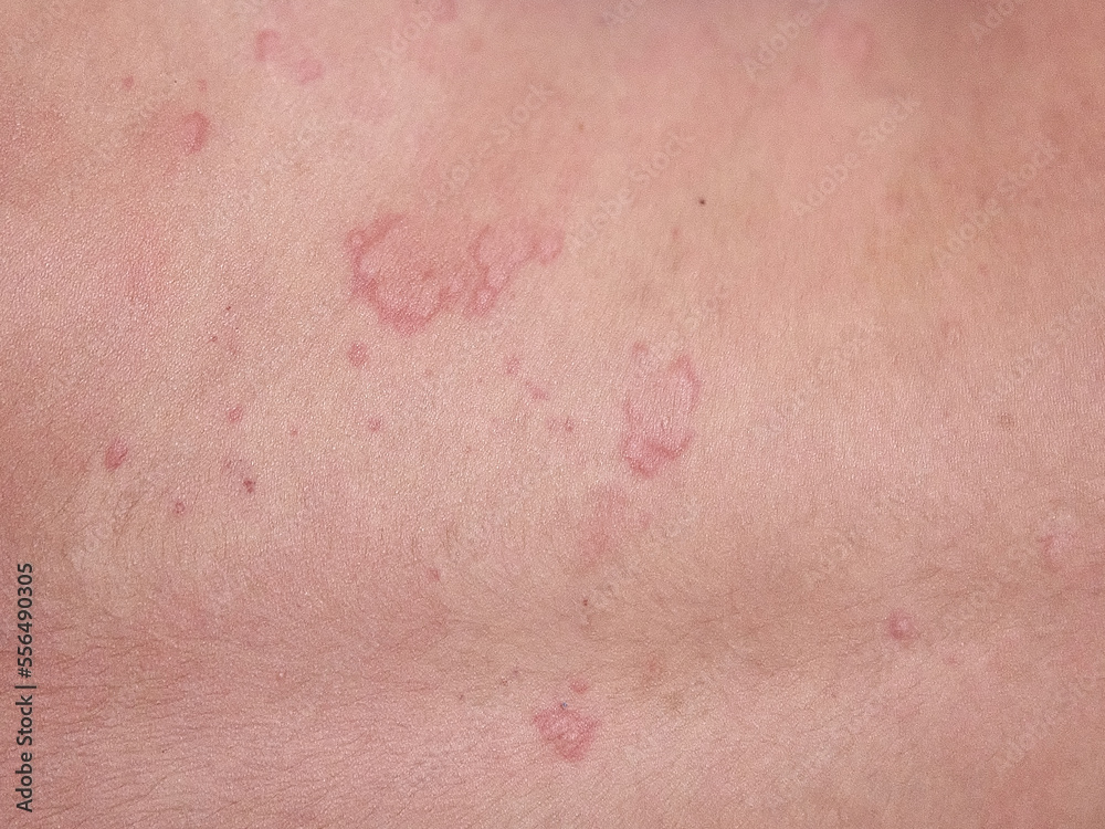 food allergy. a boy with red spots. The child has itching, with an allergic rash..