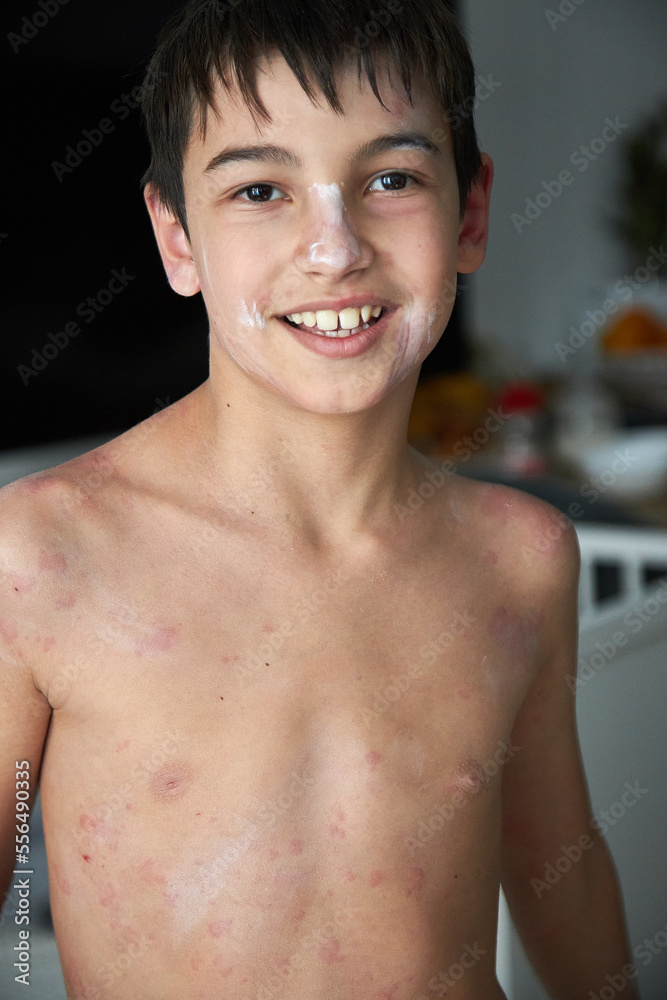 Skin itching, dermatitis, food allergy on the face. A boy with red